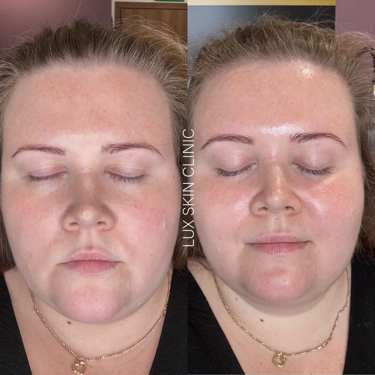 Monoacids Set Therapy w Lux Skin Clinic — zdjęcie 1