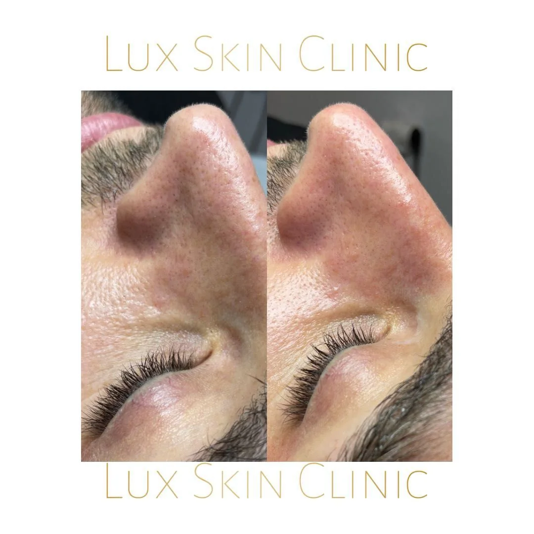 Oczyszczanie wodorowe w Lux Skin Clinic — zdjęcie 1