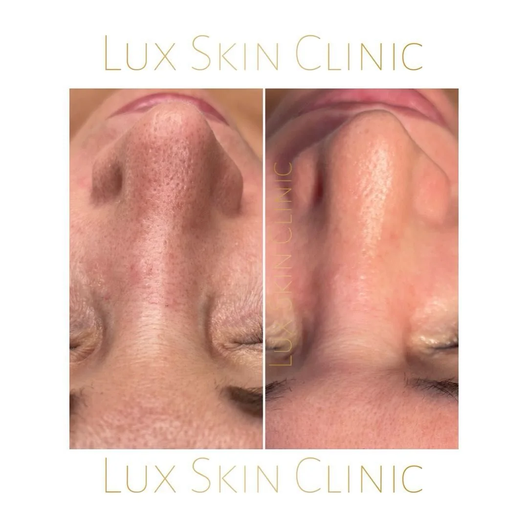 Oczyszczanie wodorowe w Lux Skin Clinic — zdjęcie 2