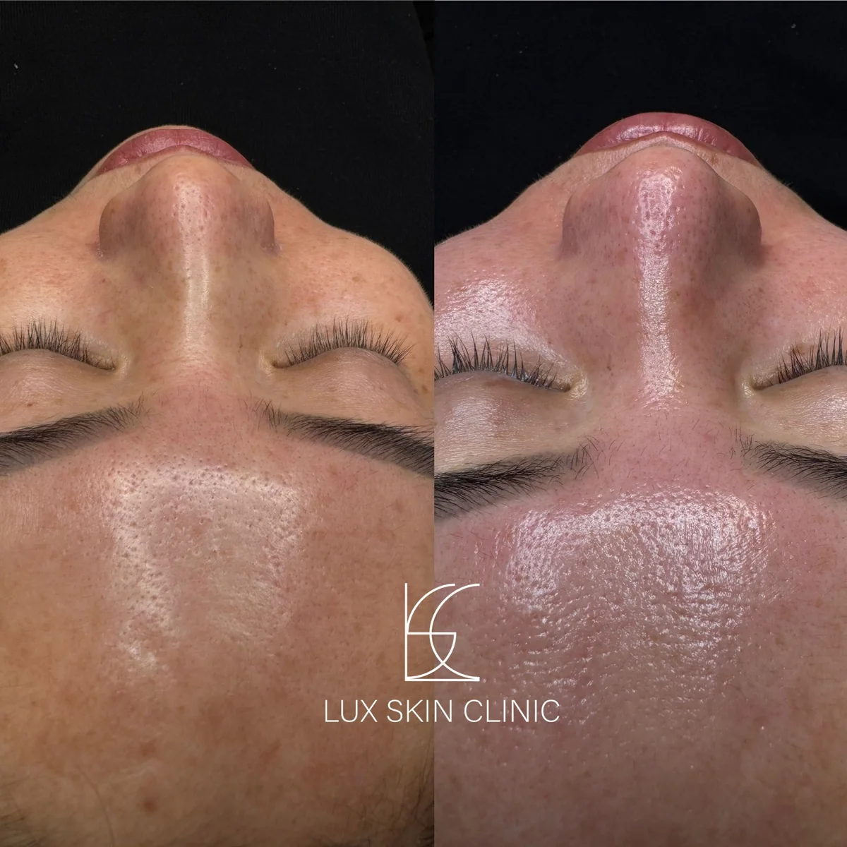 Oczyszczanie wodorowe w Lux Skin Clinic