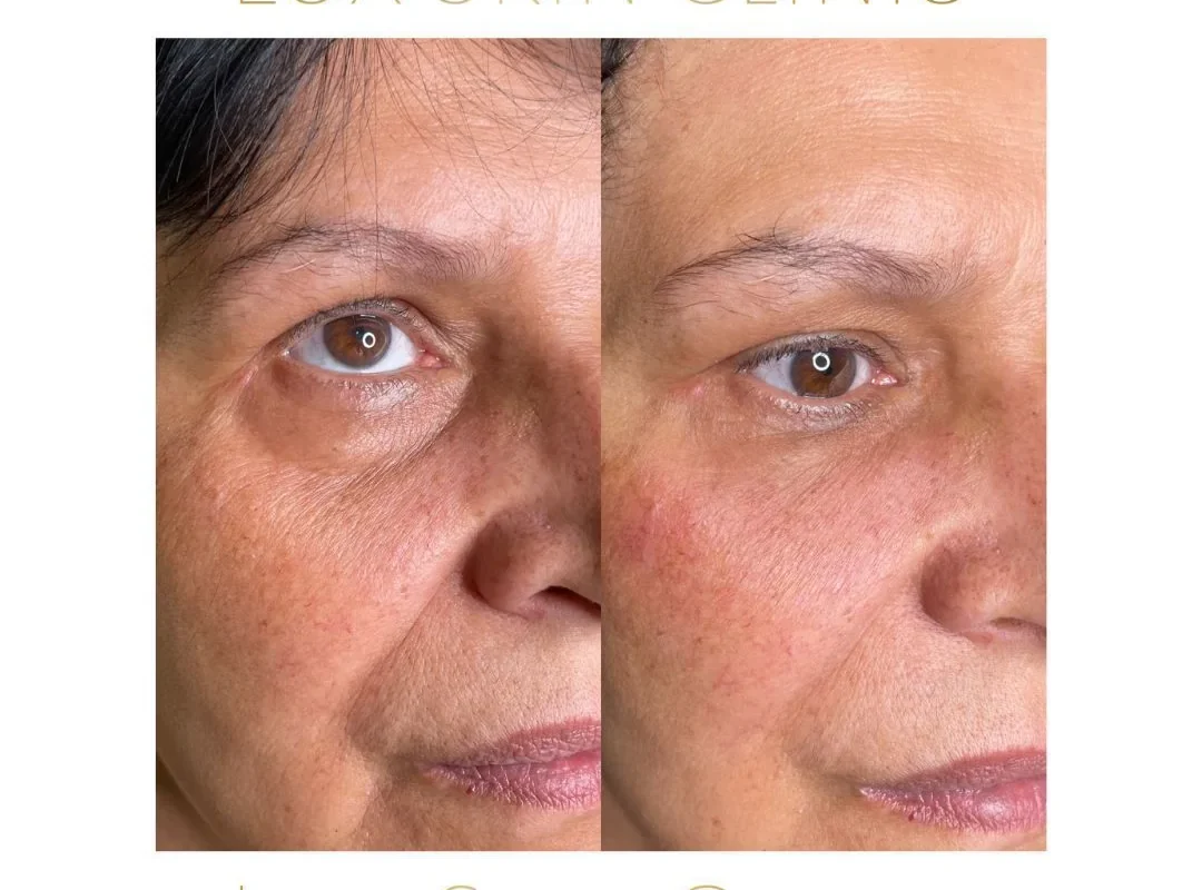 Efekty zabiegów stymulujących skórę w Lux Skin Clinic — zdjęcie 2