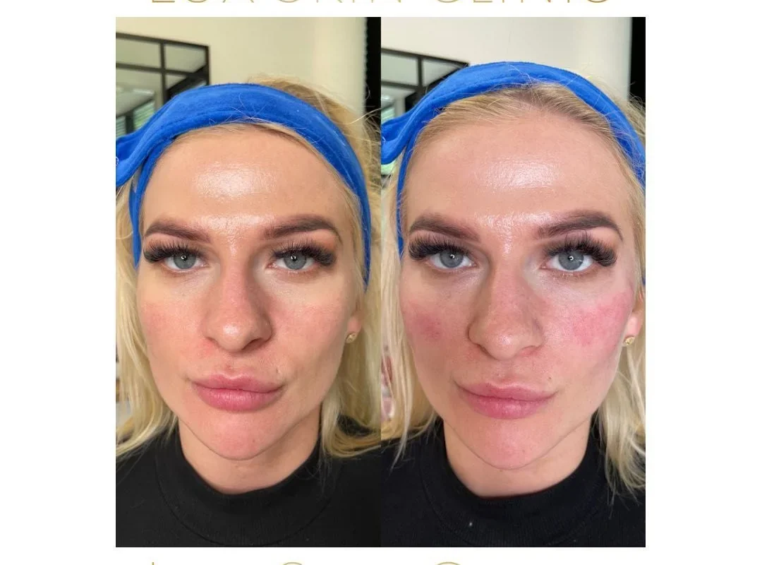 Efekty zabiegów stymulujących skórę w Lux Skin Clinic — zdjęcie 3