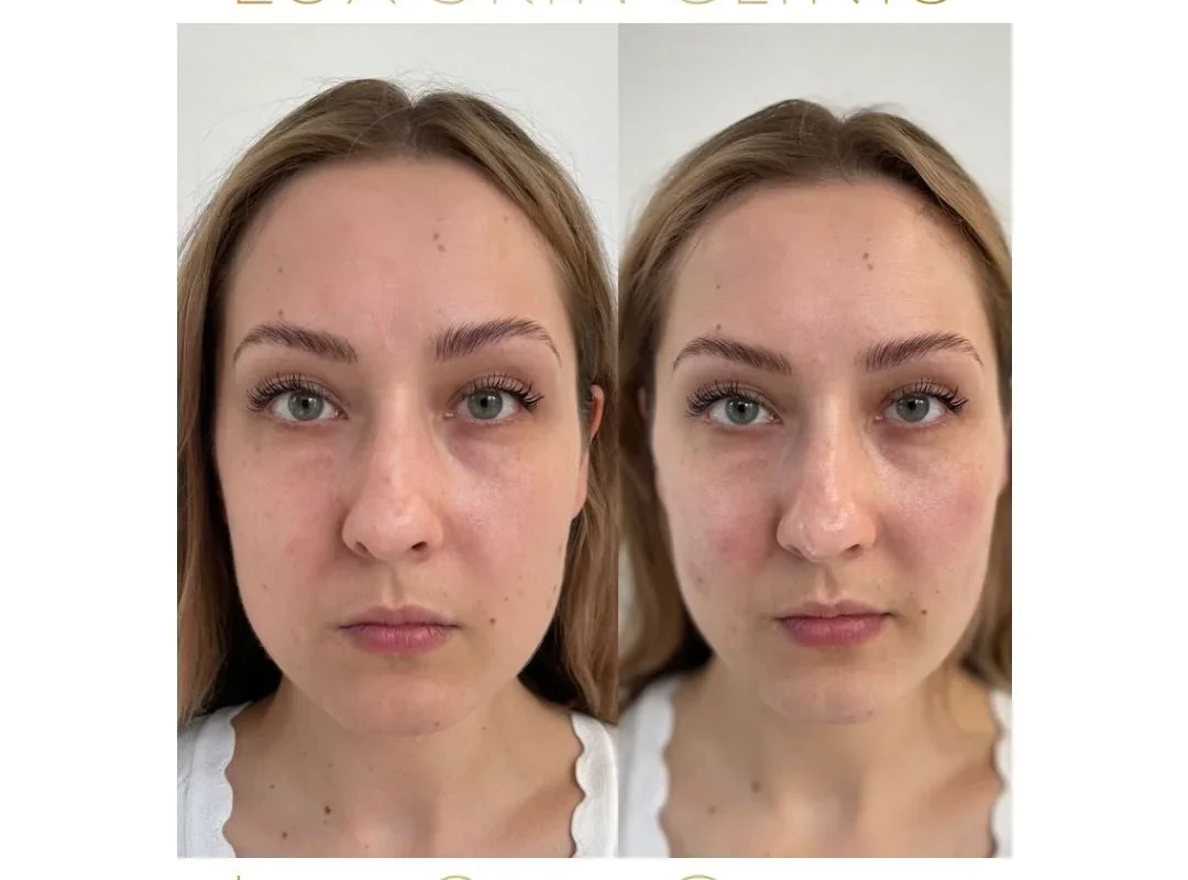 Stymulatory tkankowe w Lux Skin Clinic